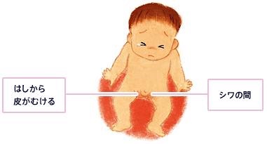 赤ちゃんのカンジダ症の説明