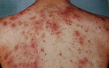 背部の酷い湿疹変化