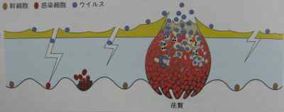 いぼ感染の模式図