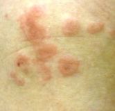 多形滲出性紅斑の皮疹