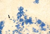 マラセチア菌の顕微鏡像