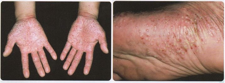 掌蹠膿疱症の臨床写真