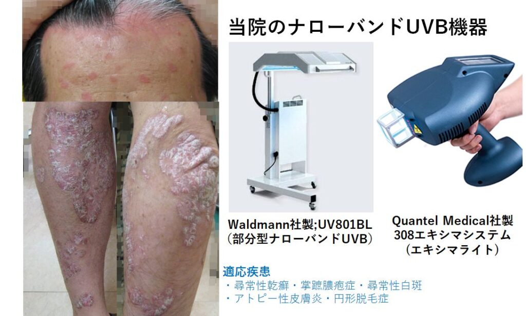 ナローバンド UVB 乾癬 アトピー - 健康用品